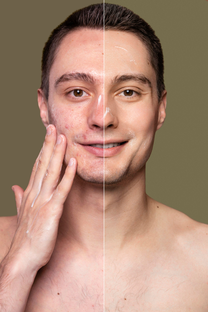 Acne & Scar Removal