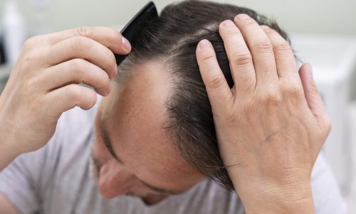 mature-man-having-balding-problems